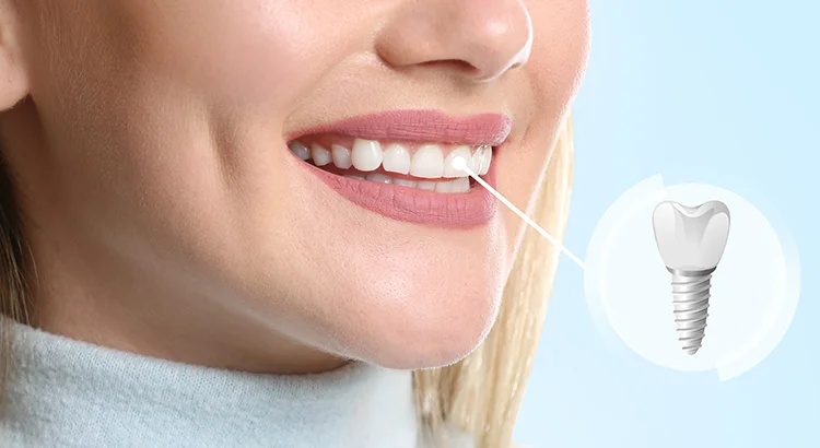 Transform Your Smile with Dental Implants in Dubai | Al Moosa Clinics