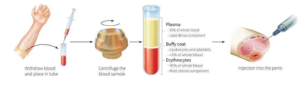 Revolutionize Your Sexual Health with the P-Shot at Almoosa Clinics