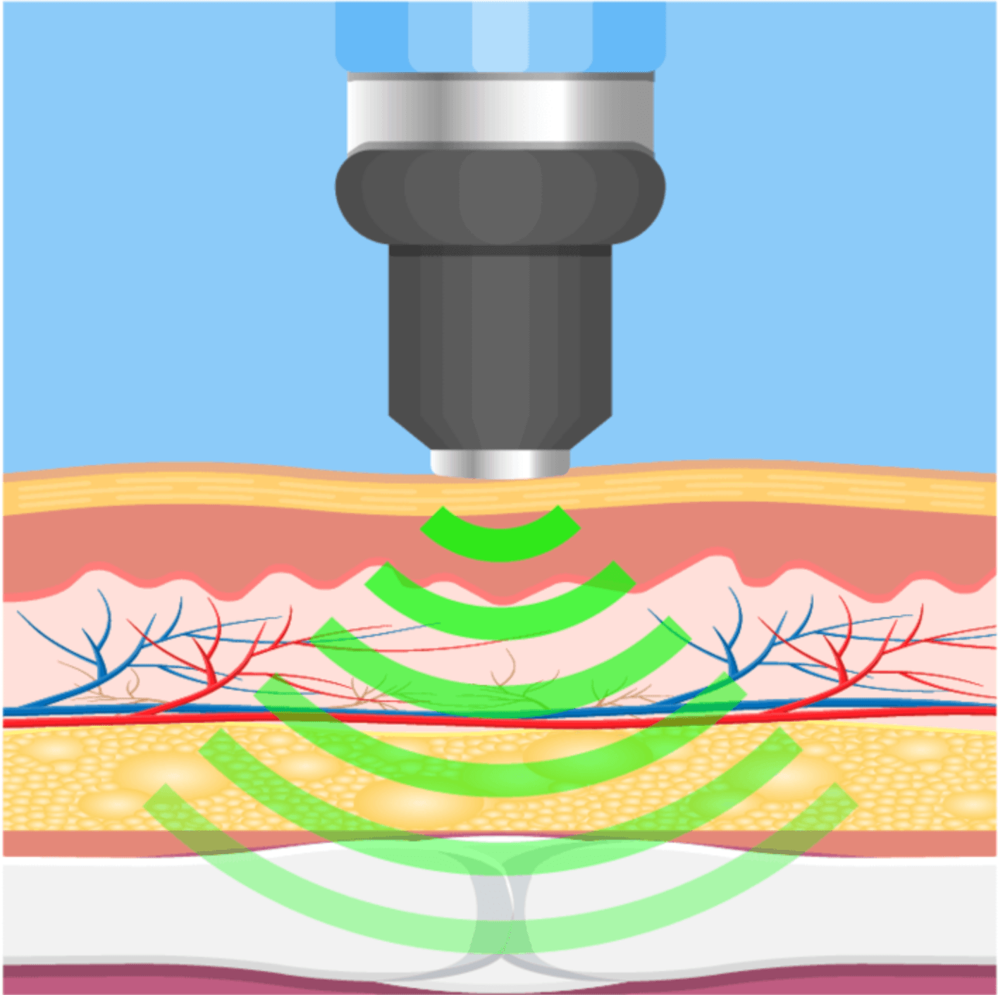 Shockwave-therapy