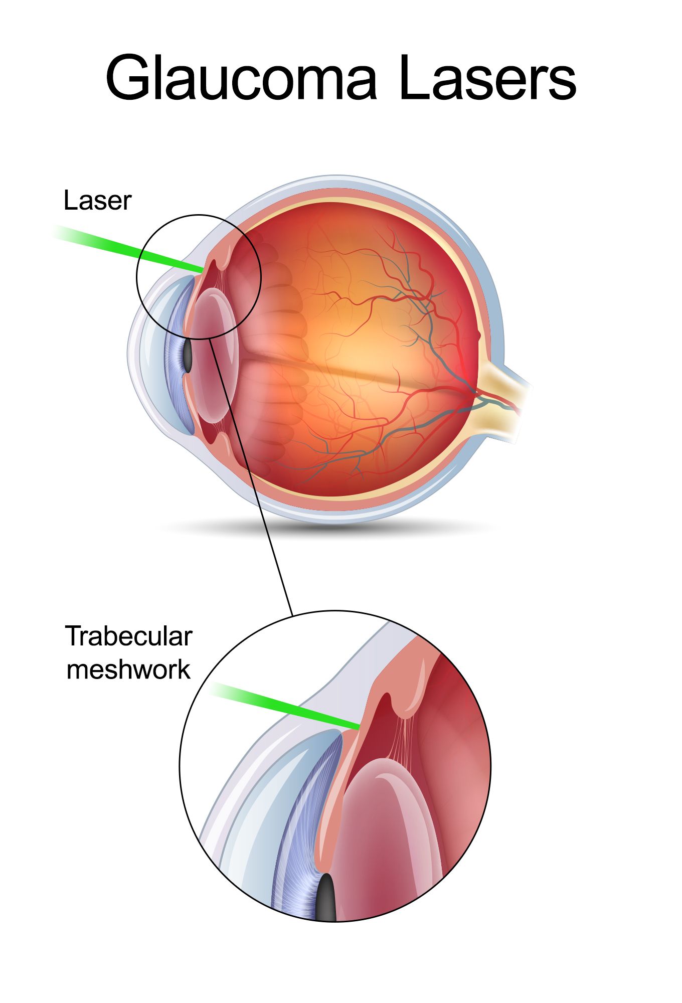 Advanced Glaucoma Surgery in Dubai | Almoosa Clinics