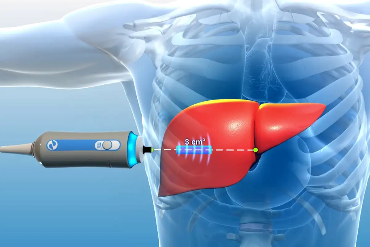 FibroScan Liver Test in Dubai | Al Moosa Clinics